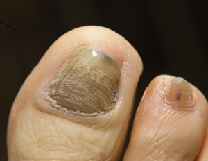 Nails and Nail Conditions