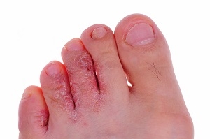 Athlete’s Foot