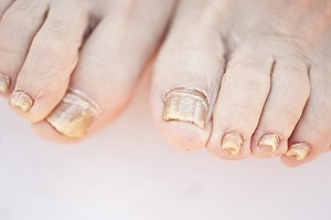 Some Facts on Toenail Infections