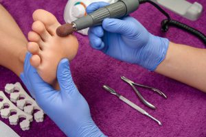 Toe Fungus Treatment exfoliation - Beauchamp Foot Care
