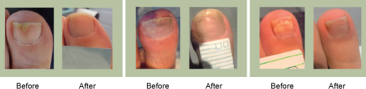 laser treatment results beauchamp foot care beauchamp foot care