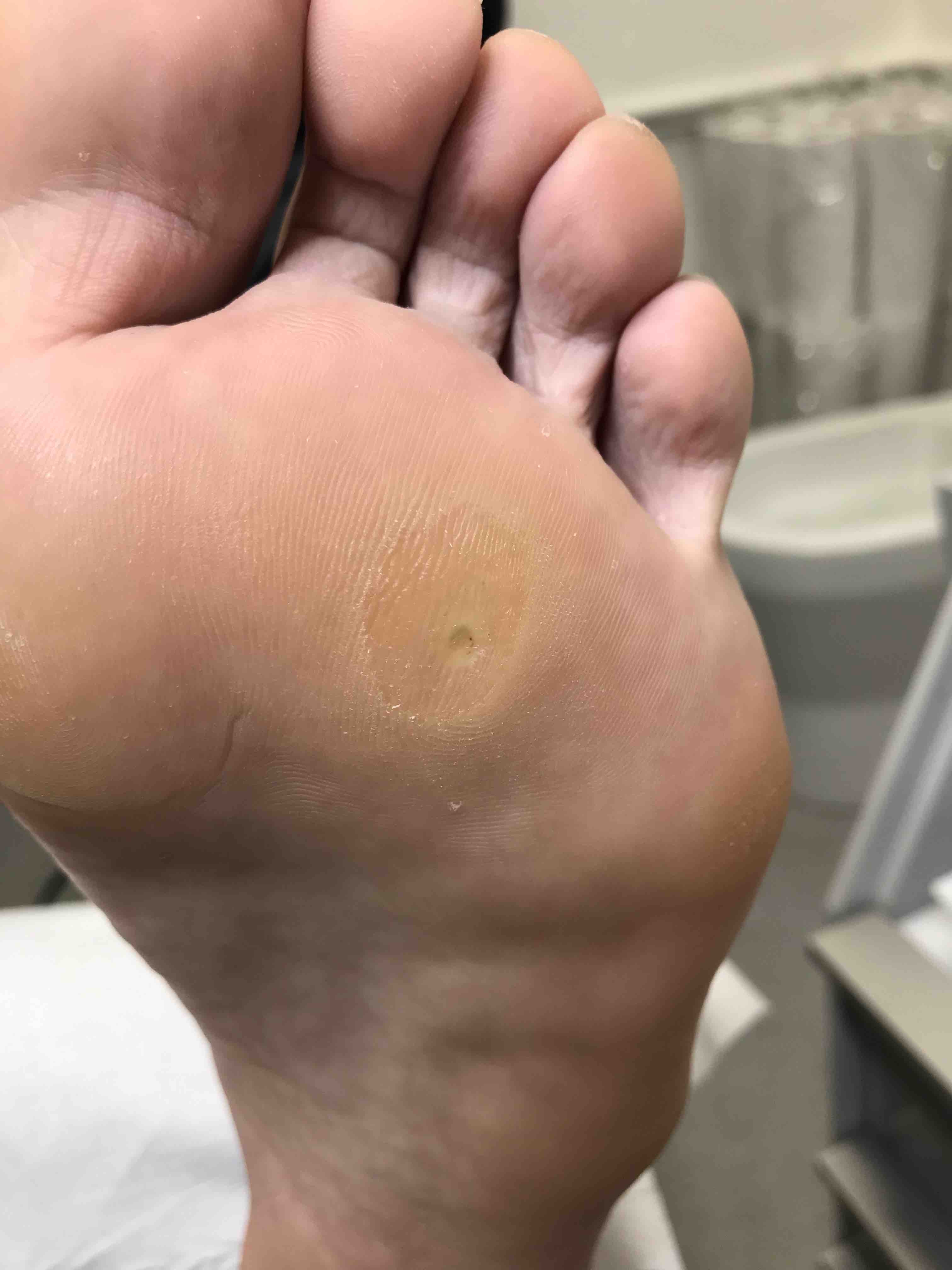 painful callus on bottom of heel