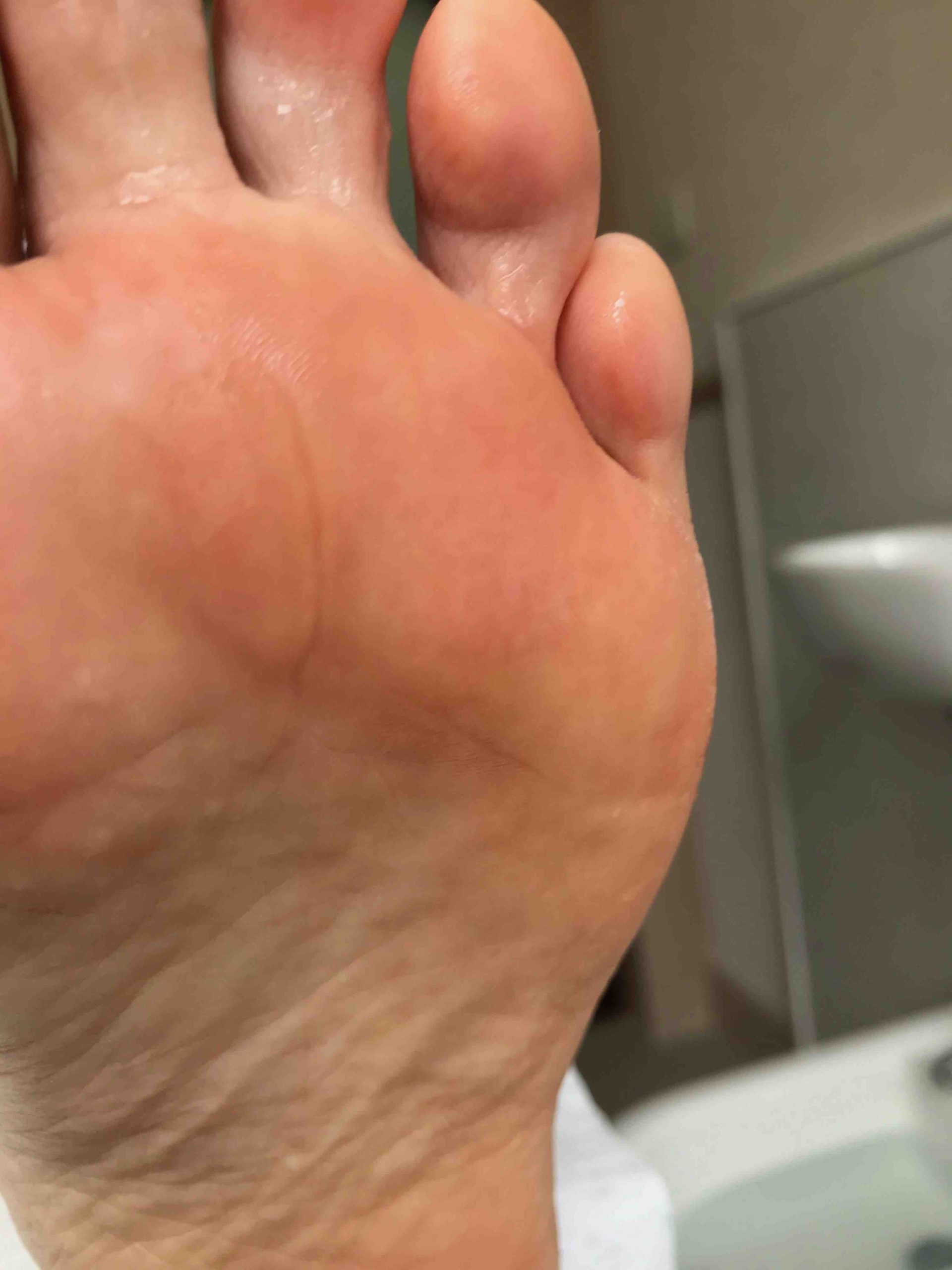 Case study: The painful verruca that proved no match for  Beauchamp Foot Care